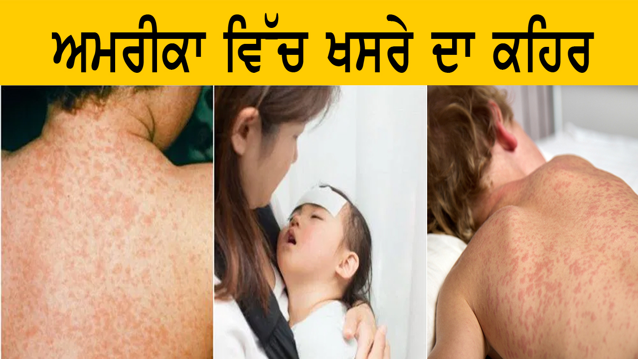 ਅਮਰੀਕਾ ਵਿੱਚ ਖਸਰੇ ਦਾ ਕਹਿਰ 